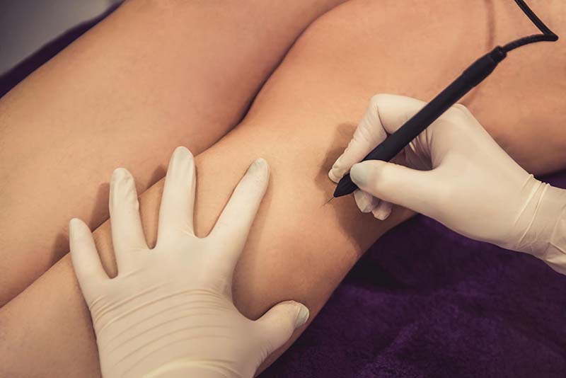 Laser Hair Removal Vaughan